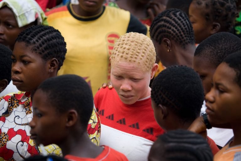 Relatora especial de la ONU pide criminalizar los abusos contra los albinos en África