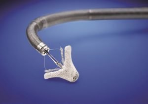 Tecnología MitraClip aumenta calidad de vida de pacientes con insuficiencia cardiaca