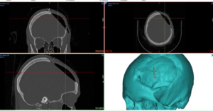 Histórico: CCSS realiza por primera vez implante de prótesis craneal fabricada con impresión 3D