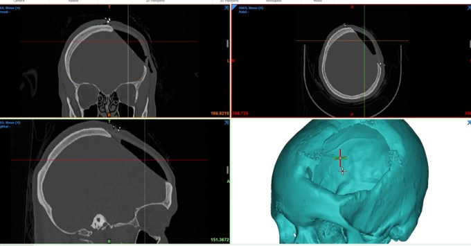 Histórico: CCSS realiza por primera vez implante de prótesis craneal fabricada con impresión 3D